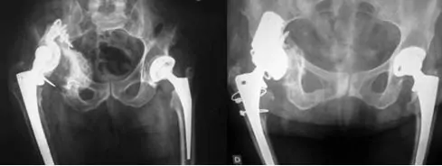 radiografía de resultados de movilización y pérdida ósea en prótesis de rodilla