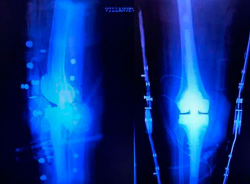 radiografia de testimonio de paciente Antibióticos para mi prótesis de rodilla