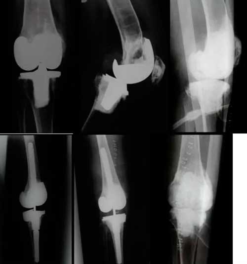 radiografía de paciente con indicación de salvamento fusión y amputación en el tratamiento de prótesis de rodilla infectada