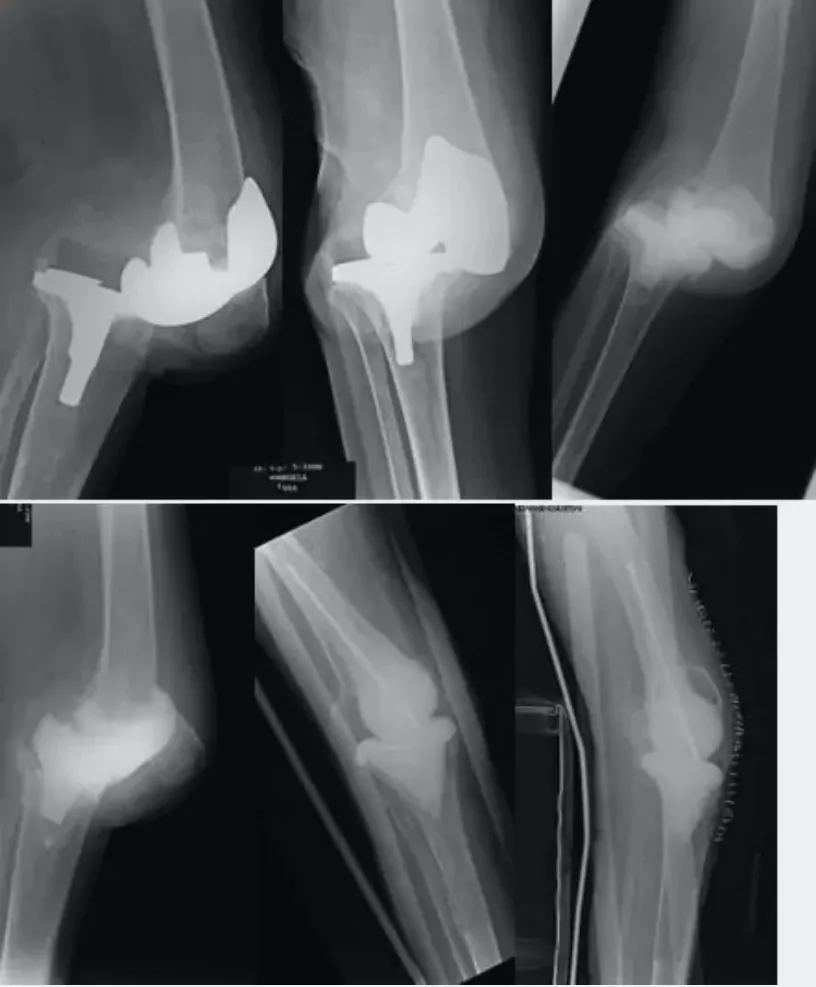 salvamento fusión y amputación para tratar la prótesis de rodilla infectada