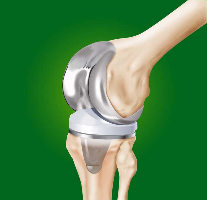 ¿Es normal que duela una prótesis de rodilla? por el especialista Dr. Villanueva