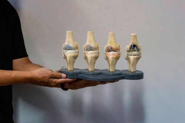 ¿Por qué fallan las prótesis de rodilla Dr. Villanueva