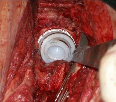 Cotilo constreñido tripular (Stryker) para recambio de prótesis de cadera no infectada