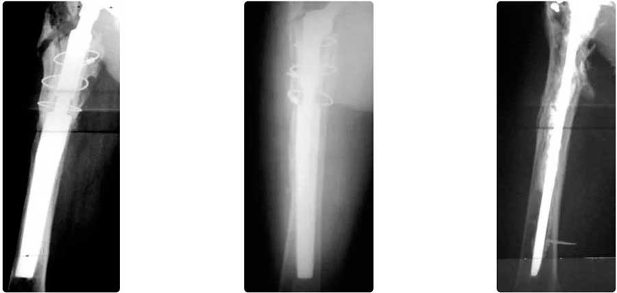 Defecto Tipo IV y revisión de prótesis de cadera Vástago cónico modular MP-Link