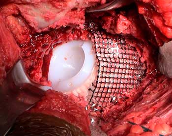 Defecto masivo acetabular tratado con impactación de injertos-2 Dr. Villanueva