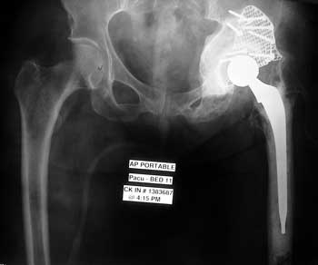 Defecto masivo acetabular tratado con impactación de injertos-3 Dr. Villanueva