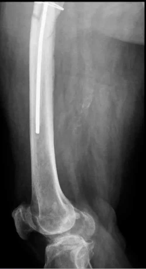 Dificultades diagnósticas en infección de prótesis de cadera