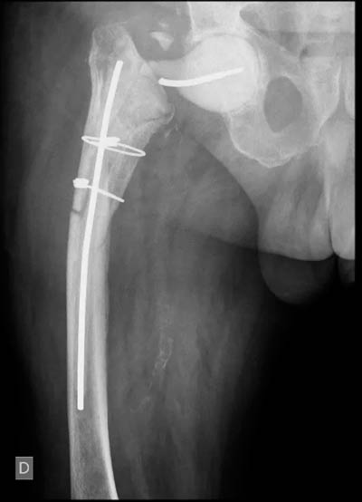 Doble fractura en el cuello de la prótesis en reconstrucción de prótesis de cadera infectada