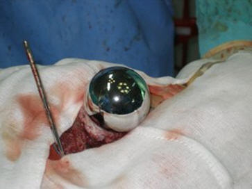 Implante femoral cementado en prótesis de recubrimiento de cadera