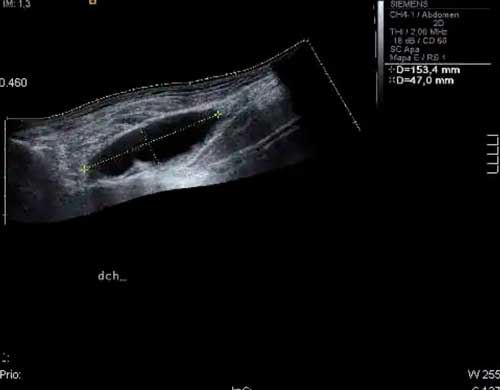Infección de prótesis de cadera en paciente joven dificultades diagnósticas