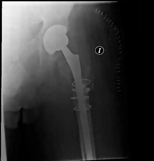 Infección en prótesis de cadera Dificultades diagnósticas