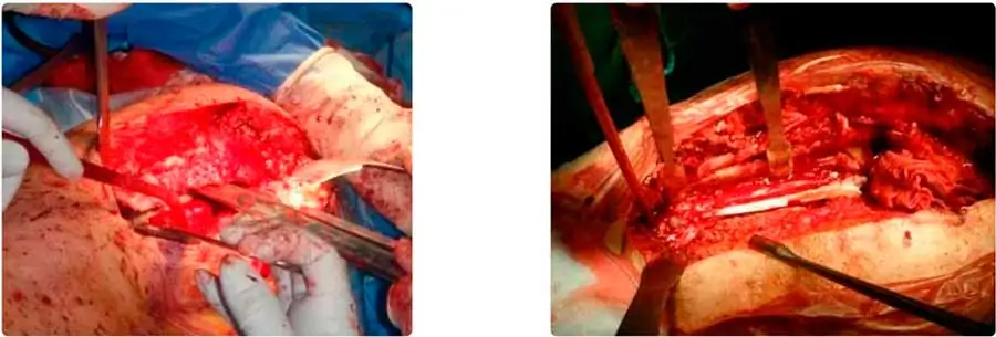 Osteotomía trocantérica ampliada para extracción y limpieza de una prótesis de cadera cementada infectada Dr. Villanueva