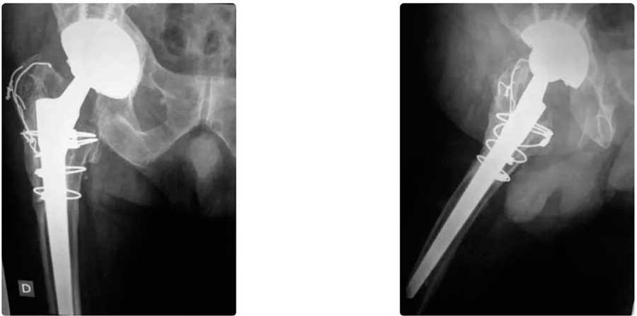 Osteotomía trocantérica ampliada ya consolidada en una reprótesis de cadera