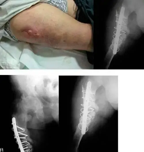 Paciente con osteogénesis imperfecta de cadera Paciente con osteogénesis imperfecta de cadera