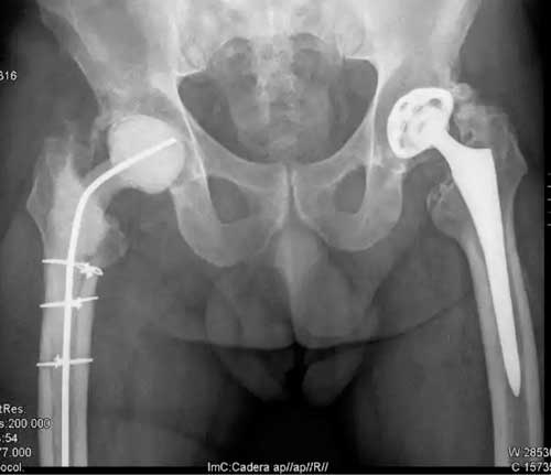 Radiografía de paciente joven con Infección de prótesis de cadera