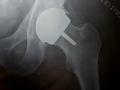 Radiografía de una Prótesis de recubrimiento de cadera