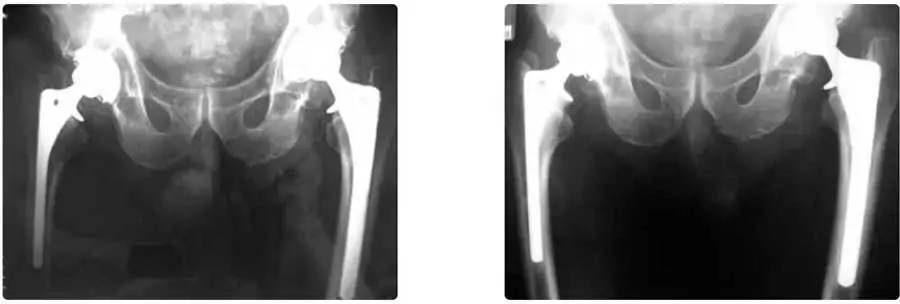 Recambio de prótesis de cadera sin infección