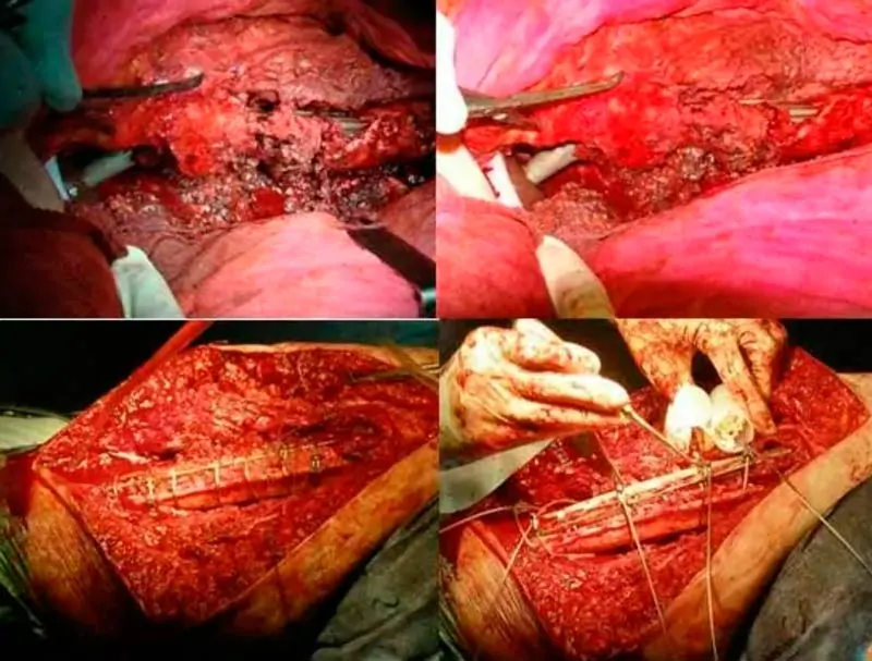 Reconstrucción durante cirugía de osteogénesis imperfecta de cadera Reconstrucción durante cirugía de osteogénesis imperfecta de cadera