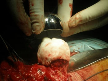 Cabeza con osteofitos y área de necrosis en prótesis de recubrimiento de cadera