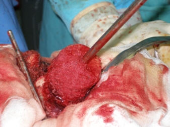 Rellenos óseos en prótesis total de recubrimientos de cadera