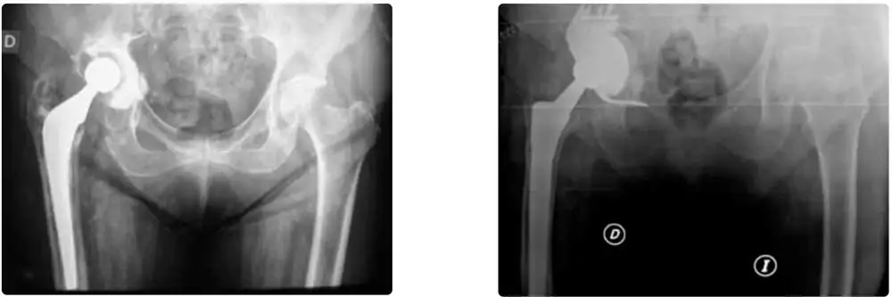 Revisión de prótesis de cadera con vástago de Wagner y Cotilo Tantalio mas dispositivo antiprotrusión “Cup-cage”