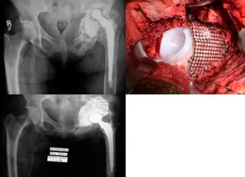 Tratamiento de las pérdidas óseas en cirugía de cadera