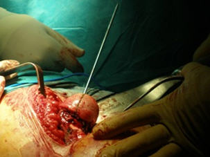 alineamiento correcto en prótesis de recubrimiento de cadera