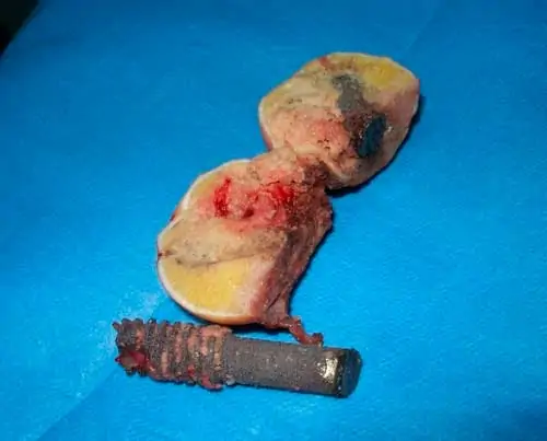 caso fracasado necrosis de cadera tratado con tornillo ultraporoso Dr. Villanueva