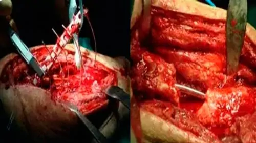 cirugía osteogénesis imperfecta de cadera cirugía osteogénesis imperfecta de cadera