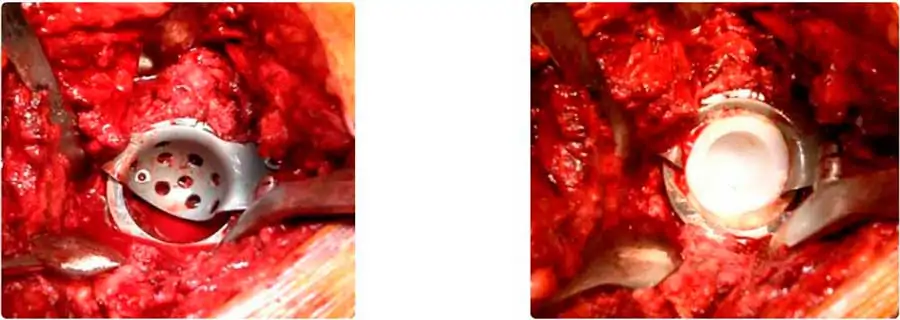 cotilo hemisférico de tantalio sobre el injerto para revisión y recambio de prótesis de cadera