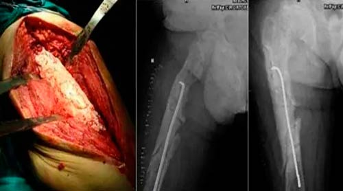 osteogénesis imperfecta de cadera y pseudoartrosis infectada