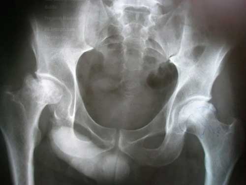osteonecrosis articular de cadera con colapso Dr. Villanueva