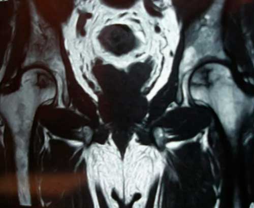 osteonecrosis en la cabeza del fémur Dr. Villanueva