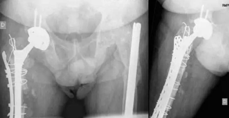 radiografías de control de cirugía osteogénesis imperfecta de cadera