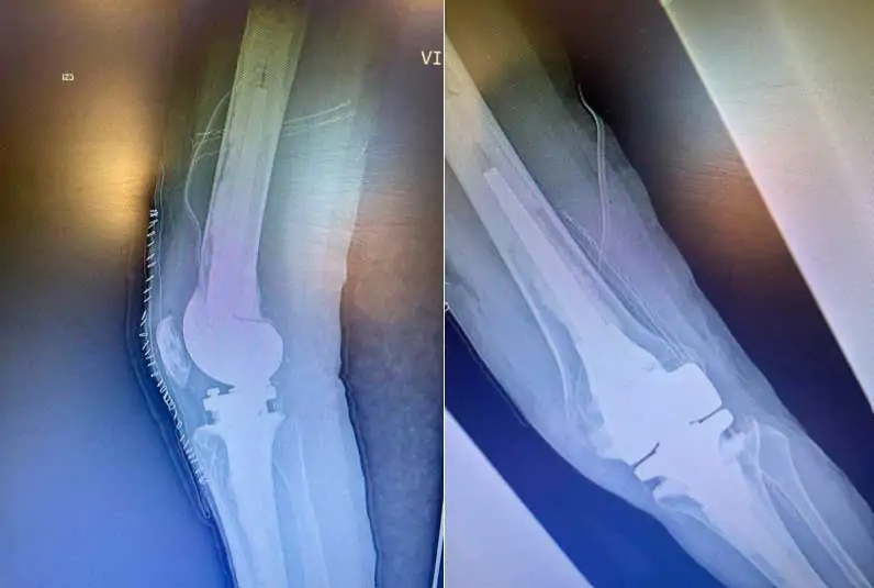 Radiografía Postcirugía por dolor e inestabilidad de prótesis de rodilla