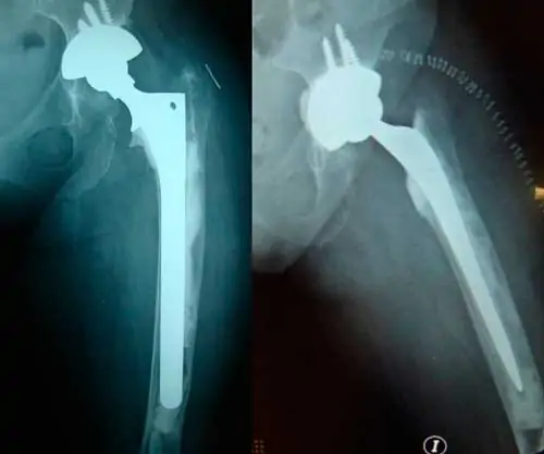 Radiografía de Valoración del fémur en revisión de prótesis de cadera