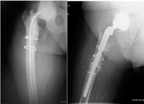 Radiografía de paciente con luxación de prótesis de cadera