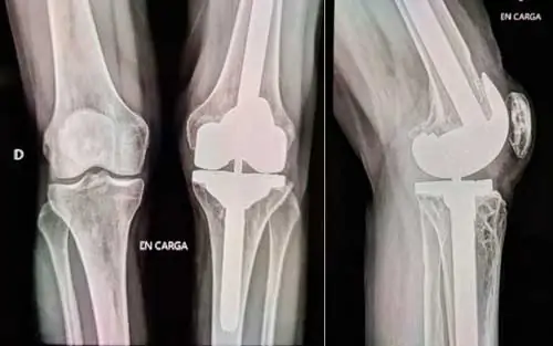 Radiografía de testimonio de dolor por inestabilidad de prótesis de rodilla