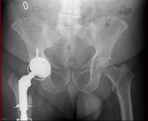 Radiografía dónde se observan las secuelas de luxación de prótesis de cadera