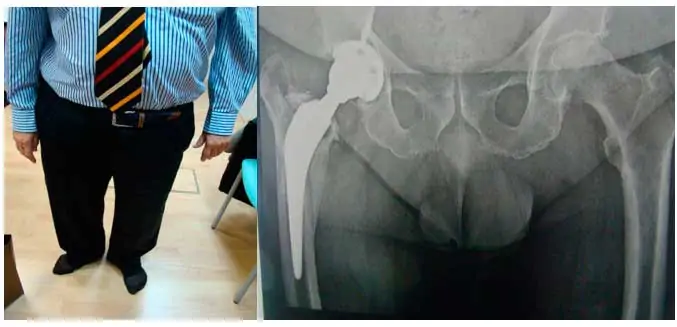 Testimonio de luxación de prótesis de cadera de un paciente del especialist