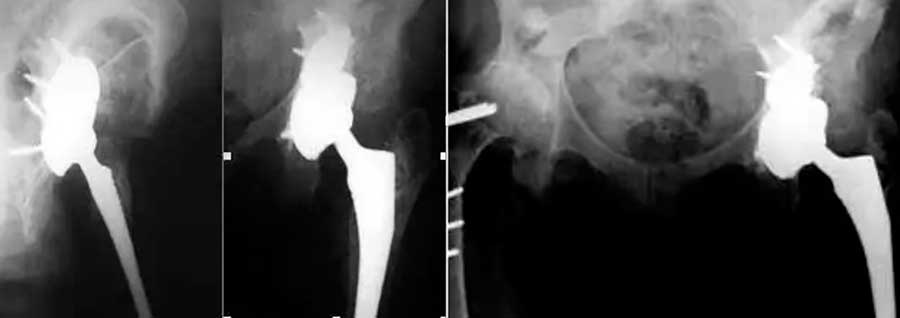 Radiografía de Valoración de defectos óseos para la revisión y recambio de prótesis de cadera Dr. Villanueva