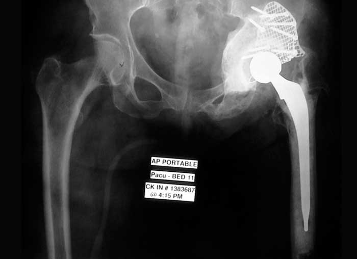 Valoración de defectos óseos para la revisión y recambio de prótesis de cadera