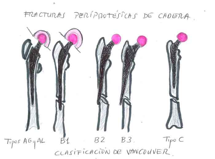 Clasificación de Vancouver de las fracturas periprotésicas de cadera