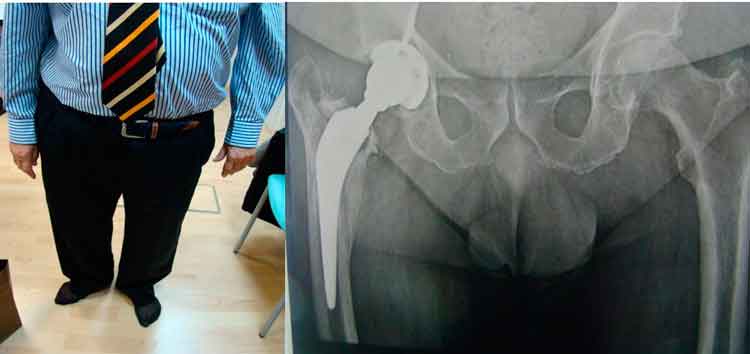 Cuándo cambiar la prótesis de cadera en los casos de fractura periprotésica