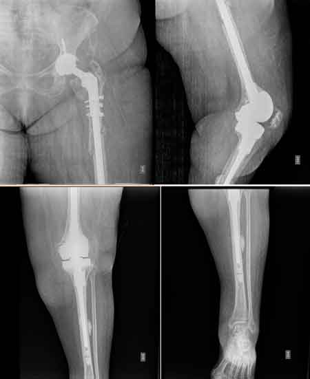 Fractura periprotésica de cadera en una paciente que requirió implantar una mega prótesis