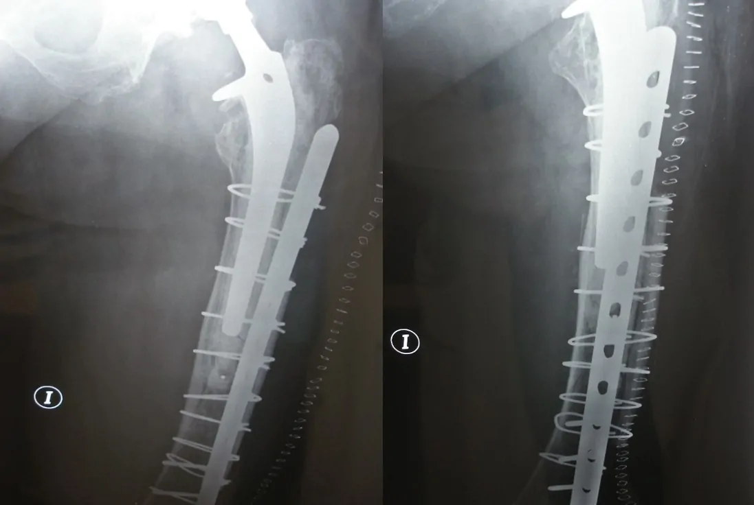 Fractura periprotésica de cadera tratada con placa de osteosíntesis más aloinjerto estructural cerclado.