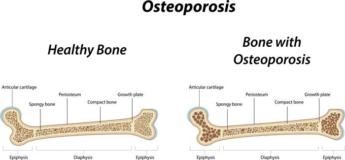 Hueso con y sin osteoporosis