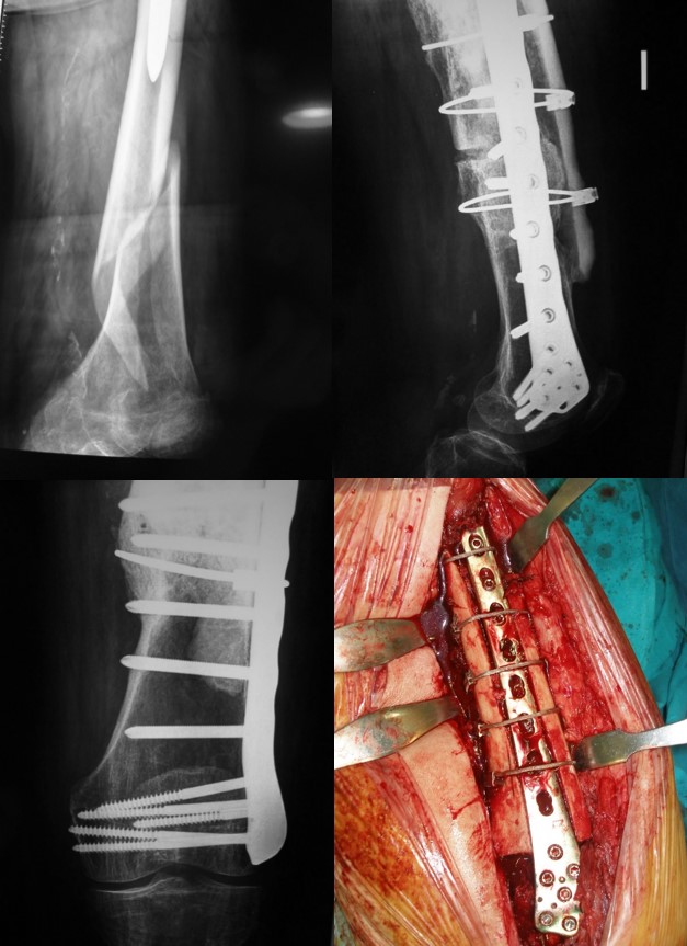 Operación de fractura de cadera periprotésica