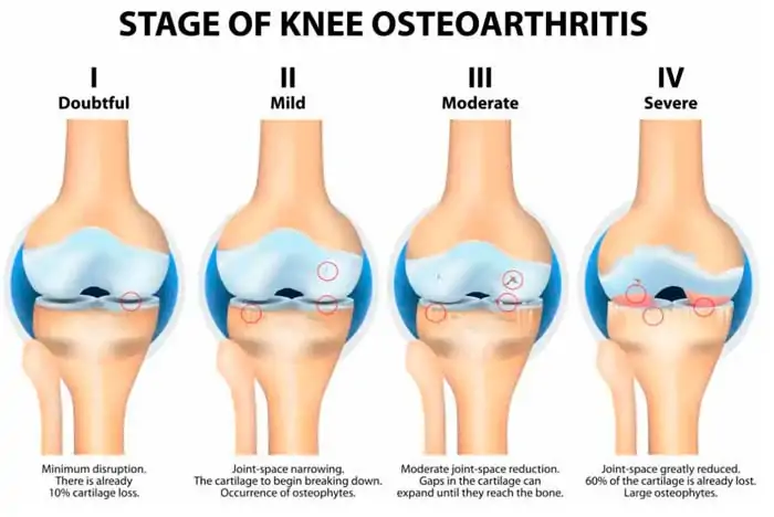 Osteoporosis Estados en Rodilla