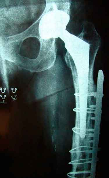Radiografía de fractura de cadera periprotésica